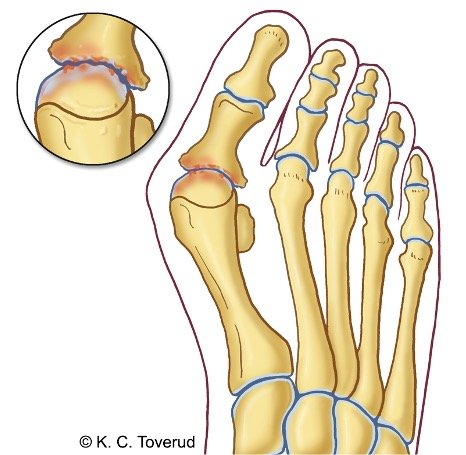Hallux valgus