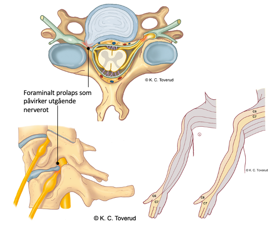 Radicular pain from a nerve root