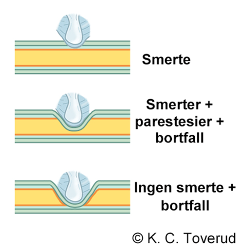 The degree of nerve compression determines the radicular symptoms