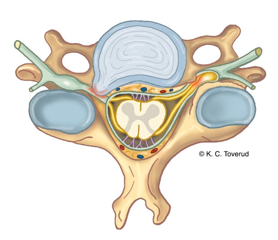 The degree of nerve compression determines the radicular symptoms