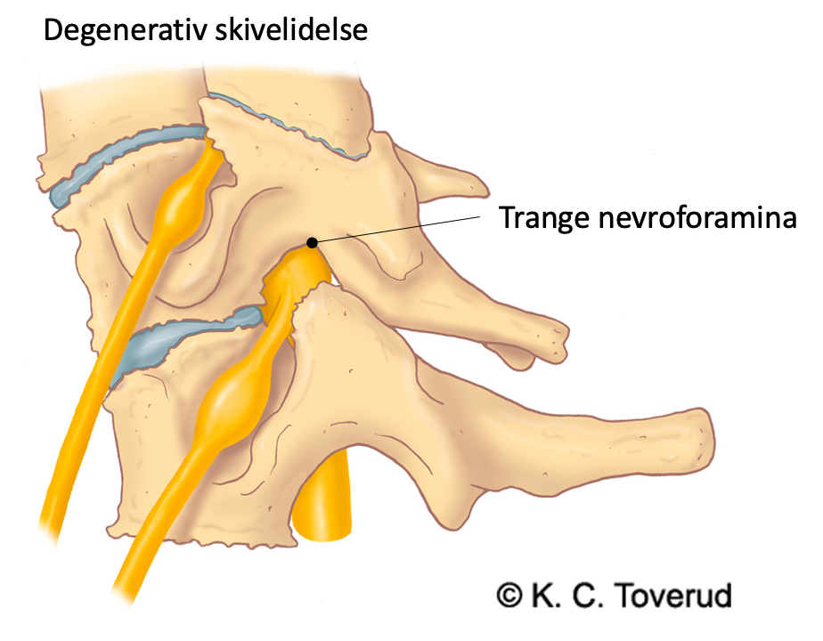 Neck, degenerative neck, cervical spondylosis